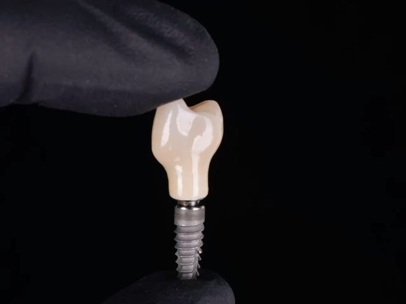 Implante dentário planejado na Leonora Parente Odontologia