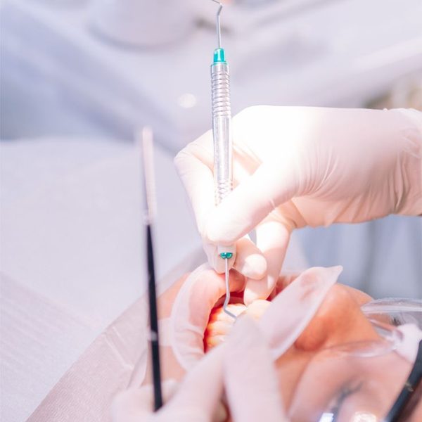 Prótese fixa sobre implantes
